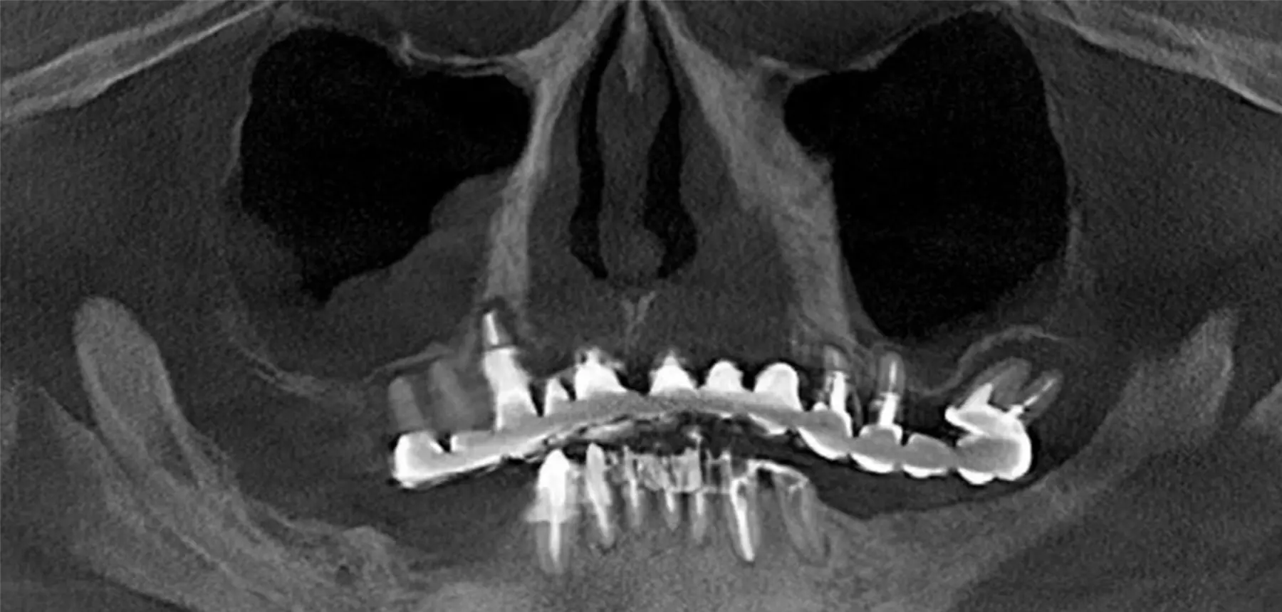 初診時のパノラミックなX線写真 ほとんどの歯がホープレスで特に上顎骨に通常のインプラントに必要な骨の高さや幅はないためザイゴマインプラントが選択されます
