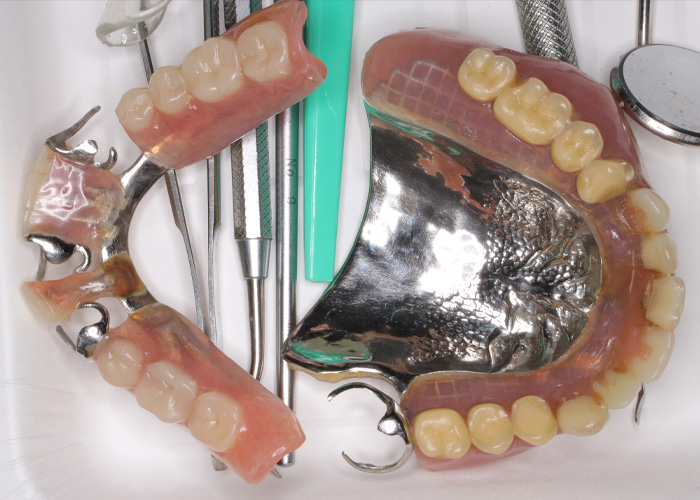 27年前に制作された金属床義歯