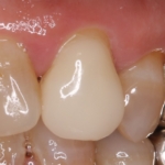 歯科教室6-保険適応の白い歯