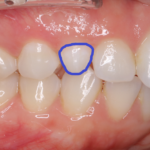 歯科教室8-矮小歯、先天欠如①