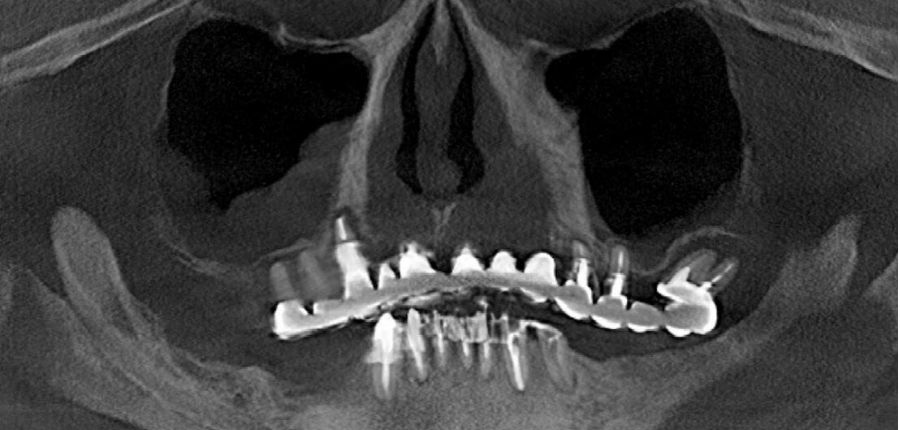 初診時のパノラミックなX線写真　ほとんどの歯がホープレスで特に上顎骨に通常のインプラントに必要な骨の高さや幅はないためザイゴマインプラントが選択されます