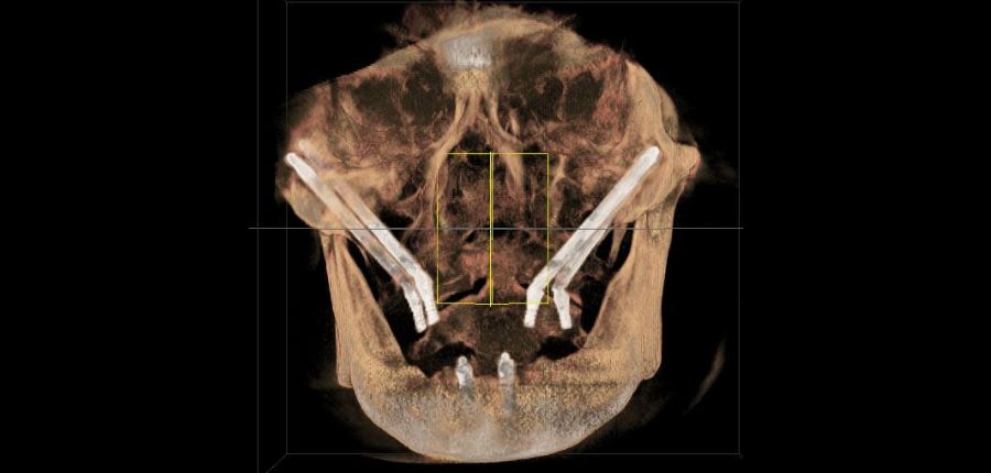 ザイゴマインプラント埋入直後の３D立体画像　1回の手術で抜歯 インプラント埋入　歯型採得　仮の歯の装着が行われます