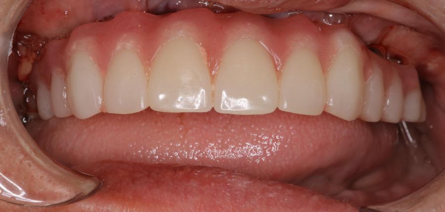 手術直後にプラスチックの仮の歯が装着されます　この仮歯をもとに最終の歯の詳細デザインに生かされます　歯型も同日に取りますので来院回数が少なくなり遠方の方に喜ばれます