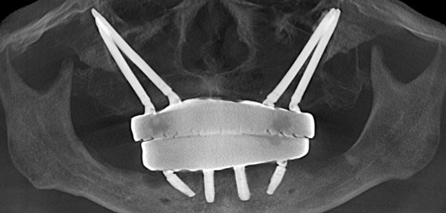 上下ジルコニアセラミック装着後のパノラミックなX線写真　4本のザイゴマインプラントで歯が支持される手術法をクアッドザイゴマと呼ばれている難しい手術法です