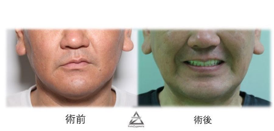 顎顔面周囲の術前術後の状態を比較したものでです　 口の曲がりも修正され最適な笑顔が手に入りました